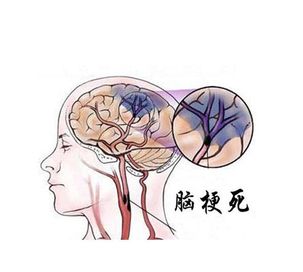 脑梗来临，头部有什么症状？